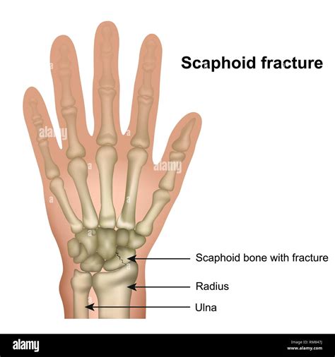 Scaphoid Tubercle