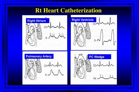 Swan Ganz Catheter Powerpoint