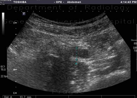 Radiology Case Acute Appendicitis On Ultrasound