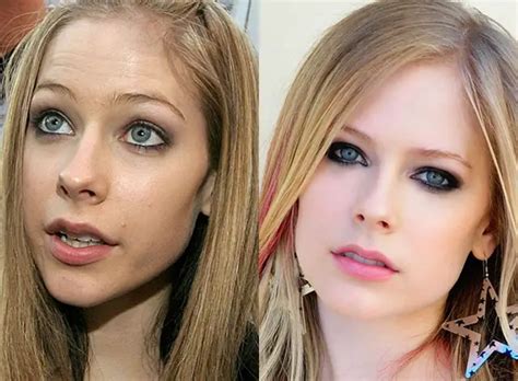 Avril Lavigne Nose Job Plastic Surgery Before And After Celebie