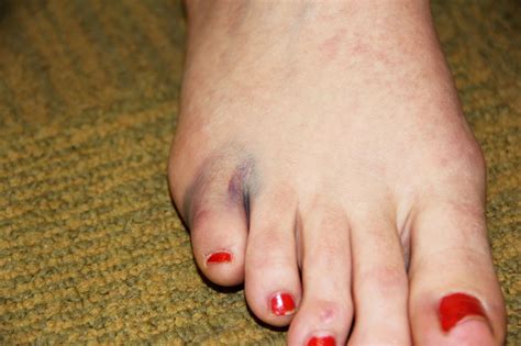 Awesome Tips About How To Tell If Your Toes Are Broken Waterask