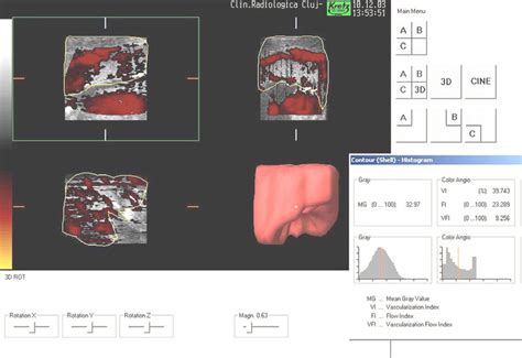 Determination Of Vascularization Indices Using The 3d Power Doppler