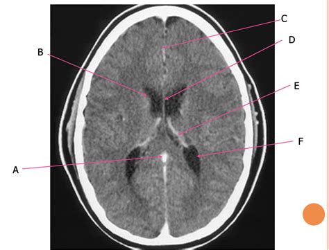 Sectional Anatomy Brain Pt 6 Diagram Quizlet