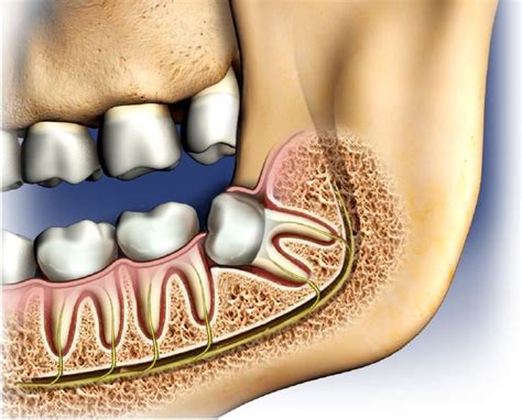 Are Your Wisdom Teeth Causing You Pain And Discomfort Wisdom Teeth