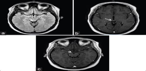 Dry Beriberi Preceded Wernicke S Encephalopathy Thiamine De