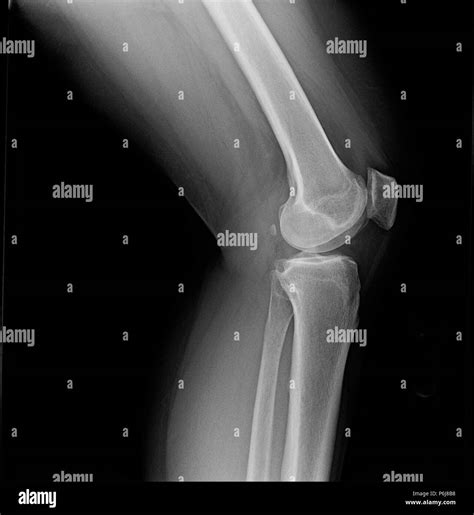 Bone Spur Stock Photos & Bone Spur Stock Images - Alamy