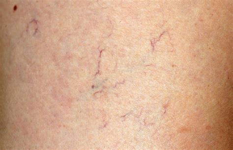 Skin Rash Liver Disease Symptoms