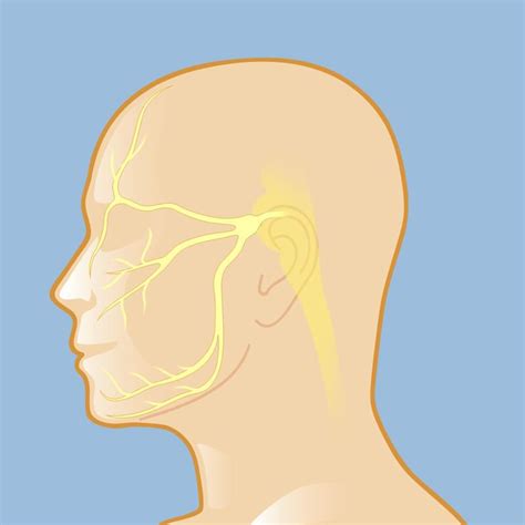 Trigeminal Neuralgia Tyler Neurosurgical Associates