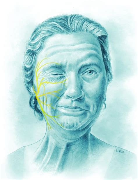 Hemifacial Spasm Causes And Treatments