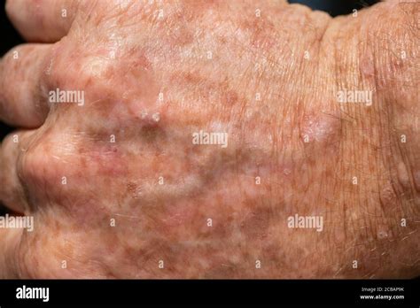 Cancerous lesion fotografías e imágenes de alta resolución Alamy