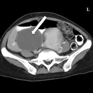 Cect Scan Showing A Mixed Solid Cystic Lesion Multiloculated Septated