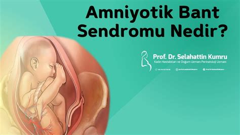 Amniyotik Bant Sendromu Nedir Prof Dr Selahattin Kumru