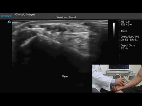 Terason S Introduction To Msk Ultrasound With Dr Skurow Part Youtube