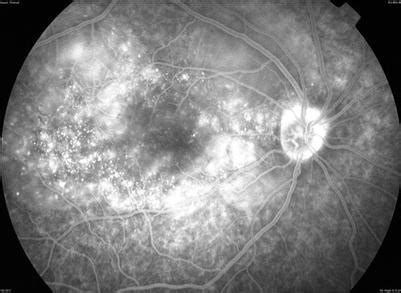 Imaging in Uveitis | Ento Key