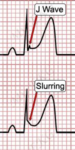 Early Repolarization