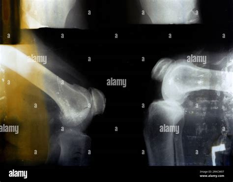 La Vieille Radiographie Rétro Plain Du Genou Droit Montre Une Arthrose