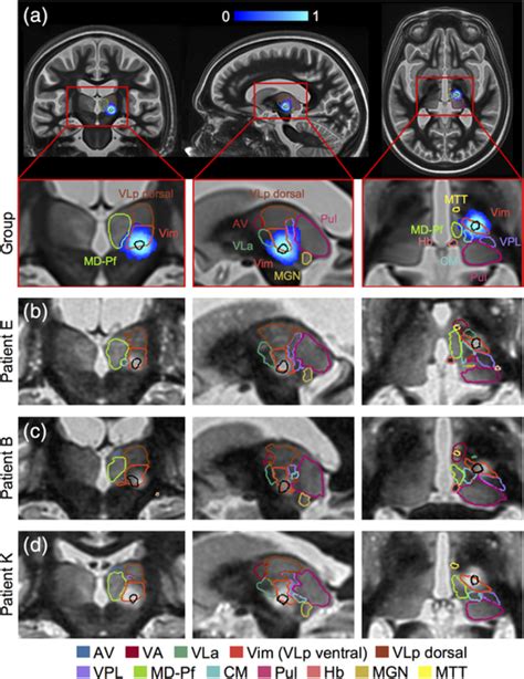 Improved Vim Targeting For Focused Ultrasound Ablation Treatment Of Essential Tremor A