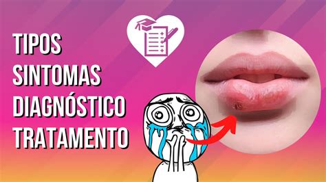 Guia Completo Tipos Sintomas Diagn Stico E Tratamento Do Herpes