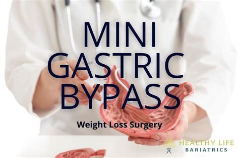 Mini Gastric Bypass Surgery For Weight Loss In Los Angeles Ca