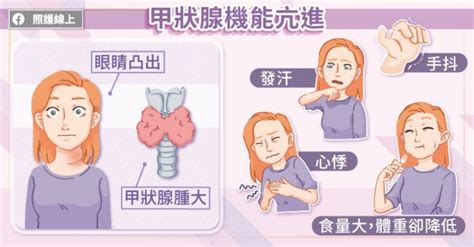 甲狀腺風暴死亡率、致命高！甲狀腺亢進病患治療、預防注意這些事 照護線上 健康遠見