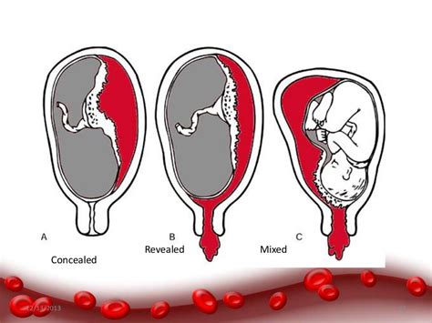 Hemorrhage In Late Pregnancy