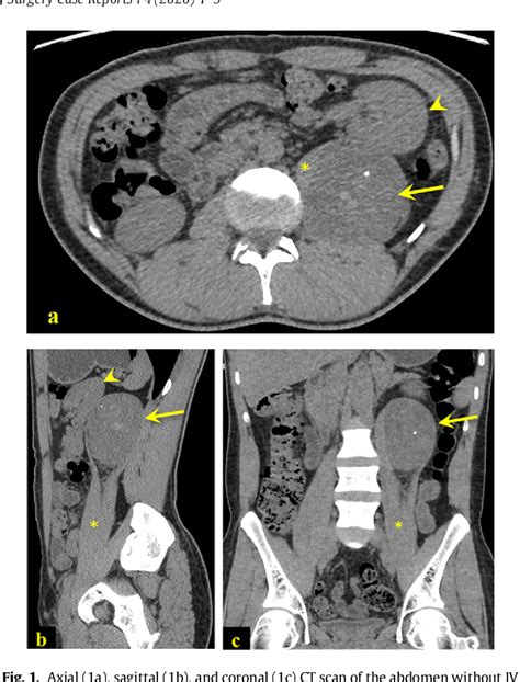 Figure From Laparoscopic Resection Of Retroperitoneal Intra Psoas