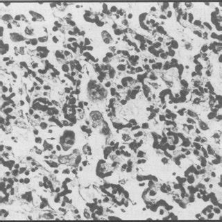 Formation of multinucleated giant cells (arrow) within bronchiolar and... | Download Scientific ...