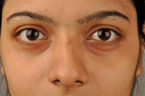 Causes Of Swollen Puffy Under Eyes