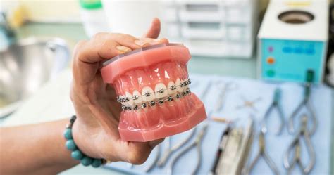 Fixing An Underbite With Orthodontics Braces And Underbites