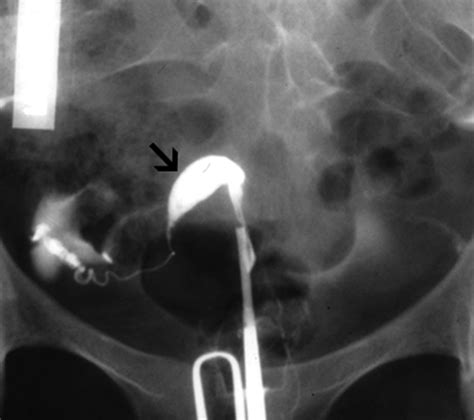 Uterine Septum Hsg