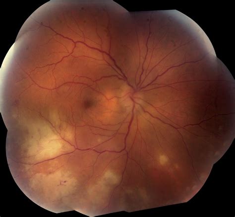 Treatment Of Acute Retinal Necrosis Ophthalmology