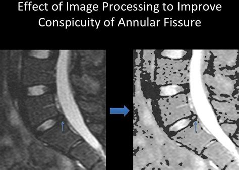 Visual Enhancement Of Annular Fissure Detection With Image Processing