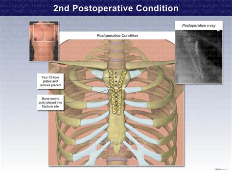 Postoperative Condition 2nd Repair Trial Exhibits Inc