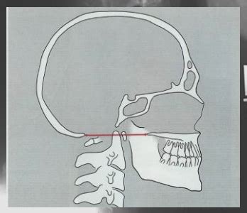 Cervical Spine Diagnostic Imaging Flashcards Quizlet