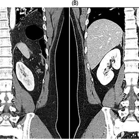 Preoperative Contrast Enhanced Abdominal Computed Tomography Coronal