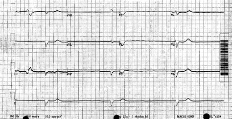 Ventricular Escape Beat ECG