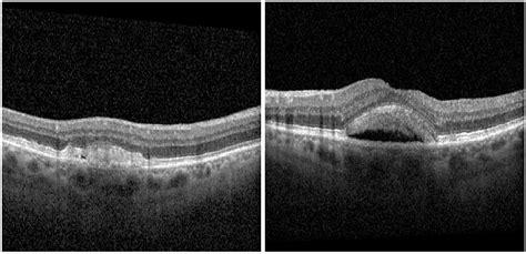 Adult Onset Foveomacular Vitelliform Dystrophy As A Masquerader Of Wet Macular Degeneration