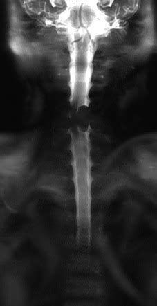 Spinal Schwannoma Image Radiopaedia Org