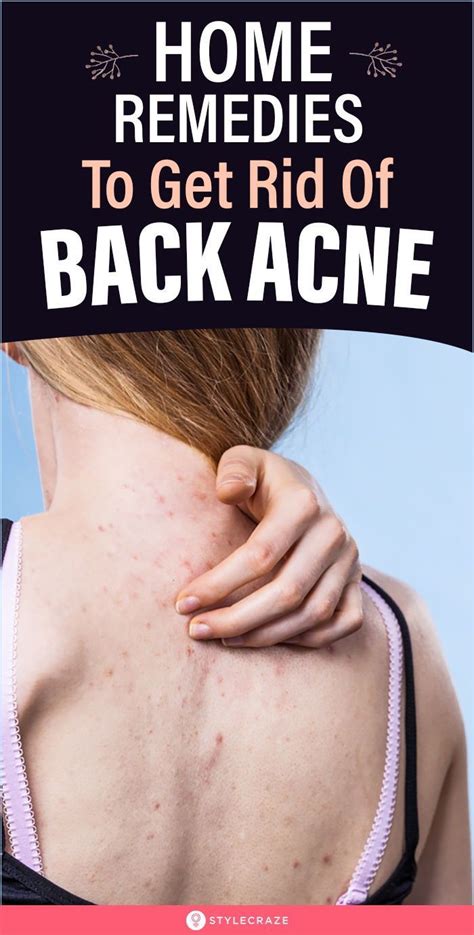 How To Get Rid Of Back Acne Using Home Remedies Artofit