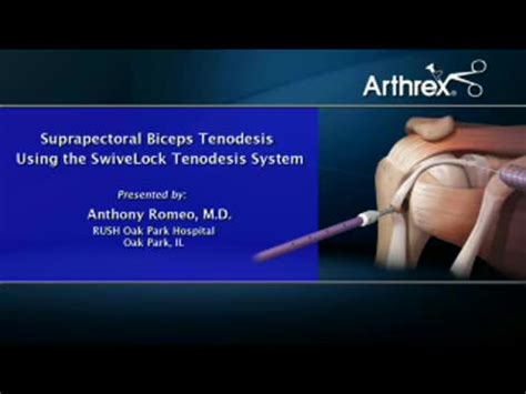 Arthrex - Suprapectoral Biceps Tenodesis Using the SwiveLock Tenodesis ...