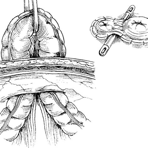 End Loop Or Defunctioned Loop Colostomy From Prasad Et Al 9 A The