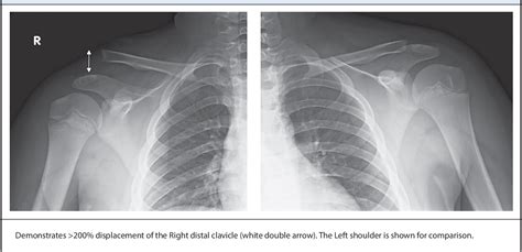 Figure 1 From Acromioclavicular ‘pseudo Dislocation’ With Concomitant Coracoid Process Fracture