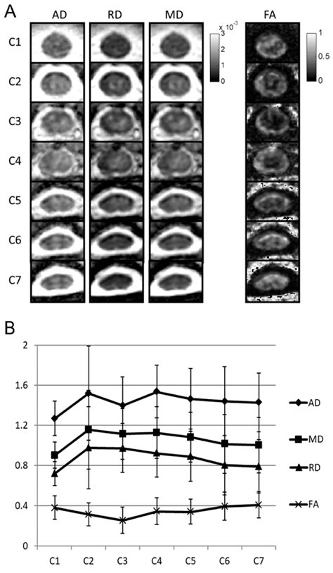 Diffusion Tensor Imaging DTI Analysis Of Spinal Cord A Axial