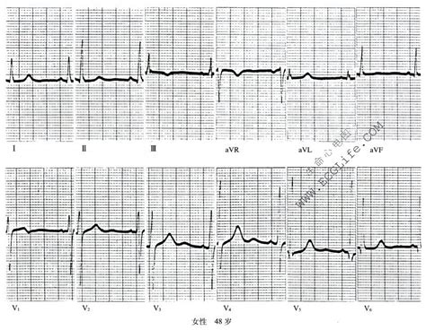 【附图】 心绞痛：心电图表现和发病机制 心电图学 天山医学院