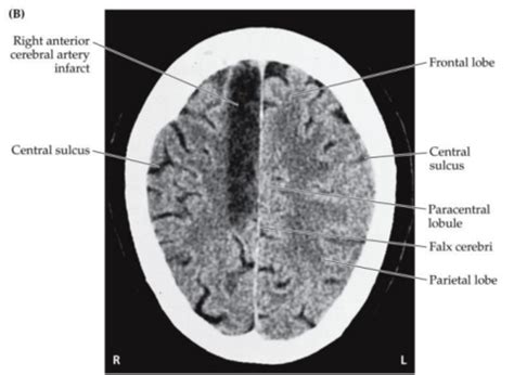 Cerebrovascular Disease I And Ii Flashcards Quizlet