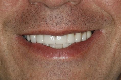 I Have Tetracycline Stains How Can I Whiten My Teeth Konig Center