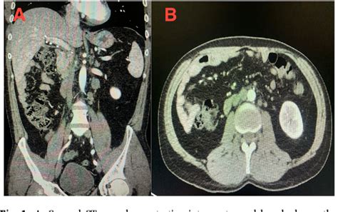 Figure 1 From Primary Testicular Teratoid Wilms Tumor In A 40 Year Old