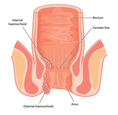 Anal Disorders Stock Vector Illustration Of Infection