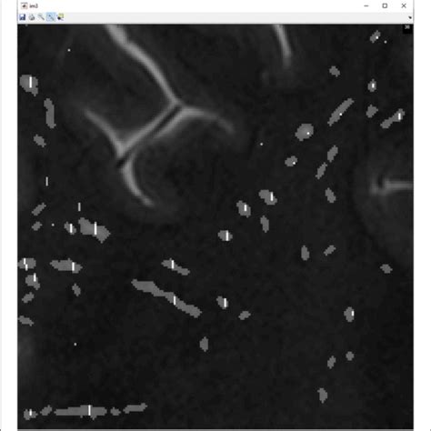 | This figure shows manually marked PVS denoted by a white line shown ...