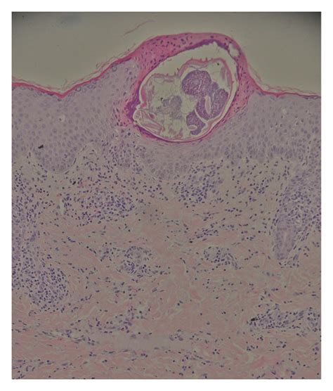 Histological Examination Of A Skin Biopsy Specimen Showed Acanthosis